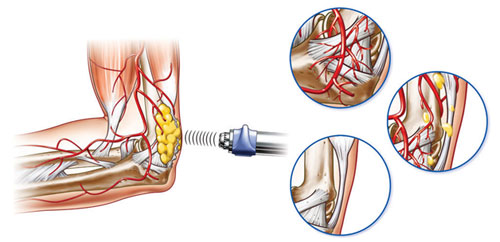 ShockwaveTherapy_02